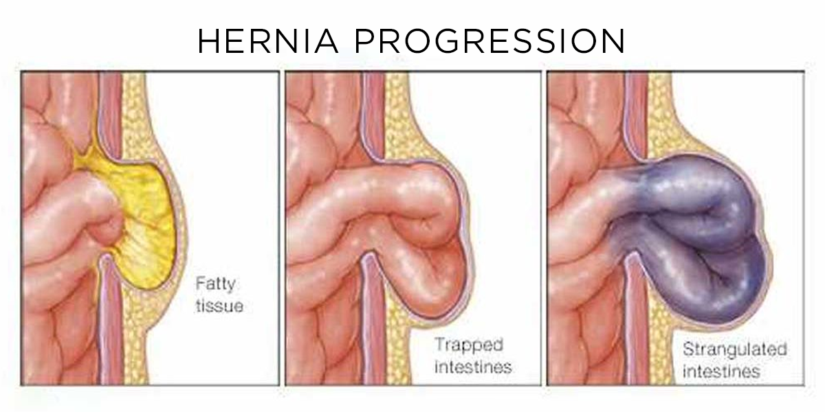 diagram showing the progression of a hernia over time